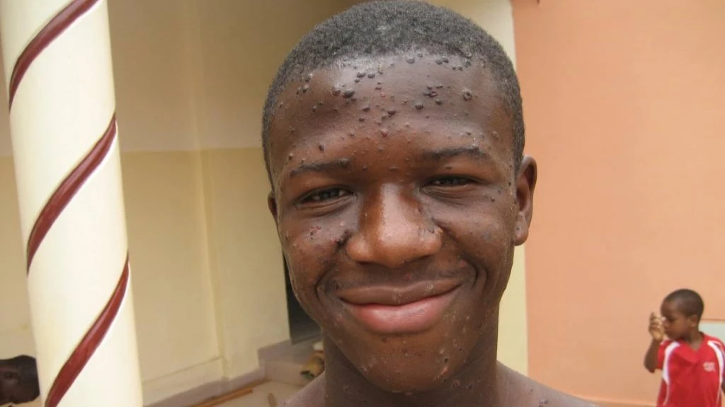 La varicelle à la maison du Bonheur