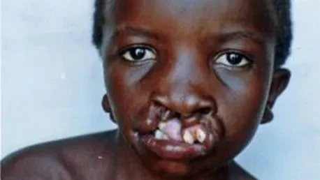 Malformation bec de lièvre , oreille ossature du squelette